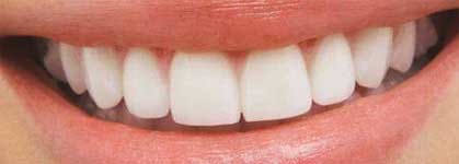 sorriso-dente-branco1 (1)